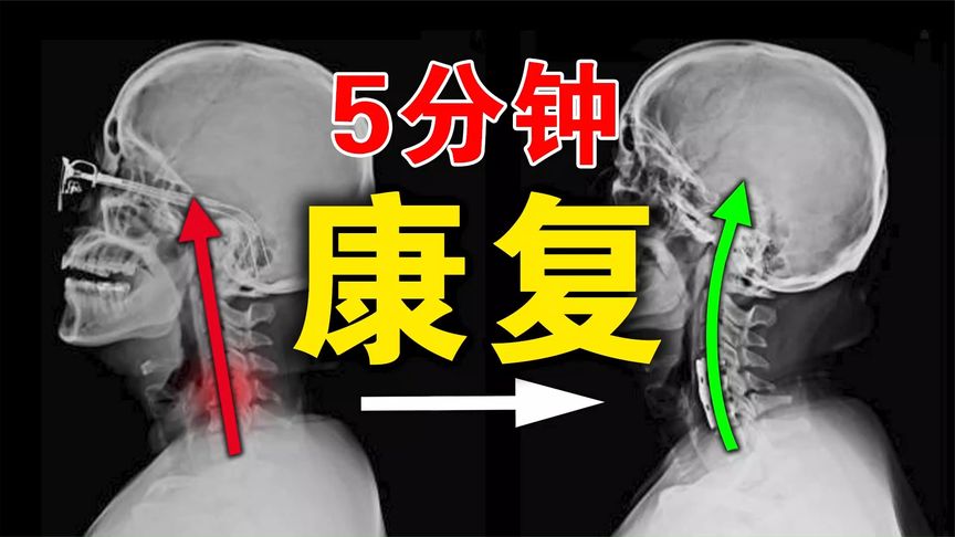 【颈椎康复训练】每天5分钟,改善颈椎僵硬不适,预防颈椎病